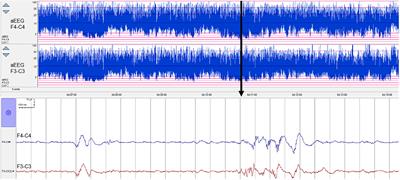 Quantitative Preterm EEG Analysis: The Need for Caution in Using Modern Data Science Techniques